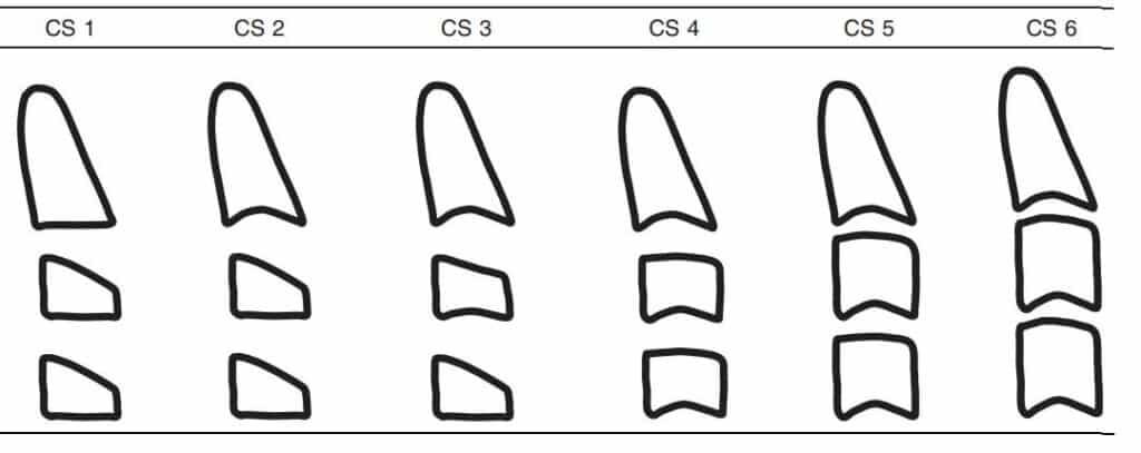 Cervical Vertebral maturation