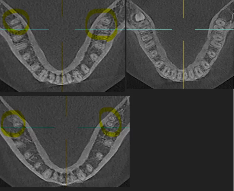 Distaliztion, CBCT, cone beam CT, limits of distalization