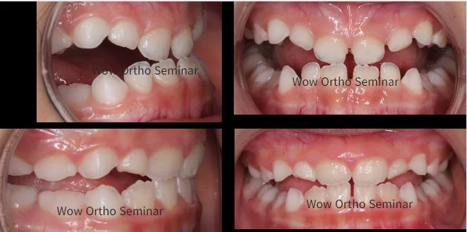 anterior crossibte treatment