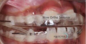 horseshoe appliance, underbite correction, crossbite