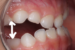 anterior crossbite, functional Class III malocclusion