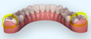 clinical crown, distalization,orthodontic