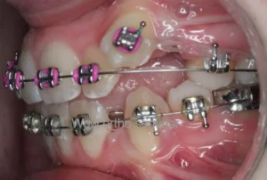 orthodontic biomechanics