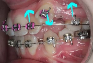 orthodontic biomechanics