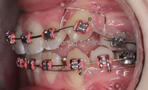 orthodontic biomechanics