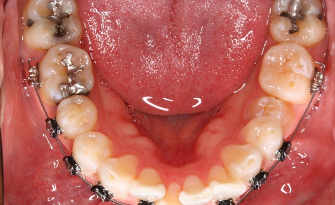 How to prevent orthodontic wire from poking Wow Ortho Seminar